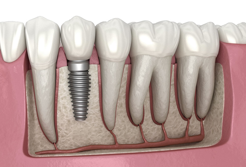 Restore Your Smile with Dental Implants in Marina del Rey – BDnews55.com