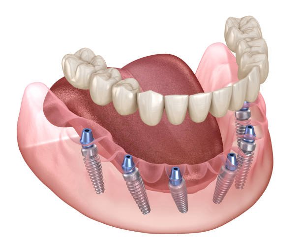 What Happens to the Jaw After Tooth Loss and Why Timing Can Matter – Telegraph